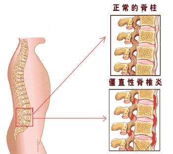 南京强脊诊疗中心强直性脊柱炎研究院
